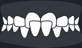 Crossbite